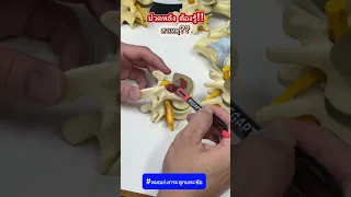  ทำไมคนไข้ถึงมีอาการปวดหลังและชาลงขา 