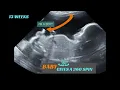 13 weeks Baby boy does 360 spin in womb Ultrasound