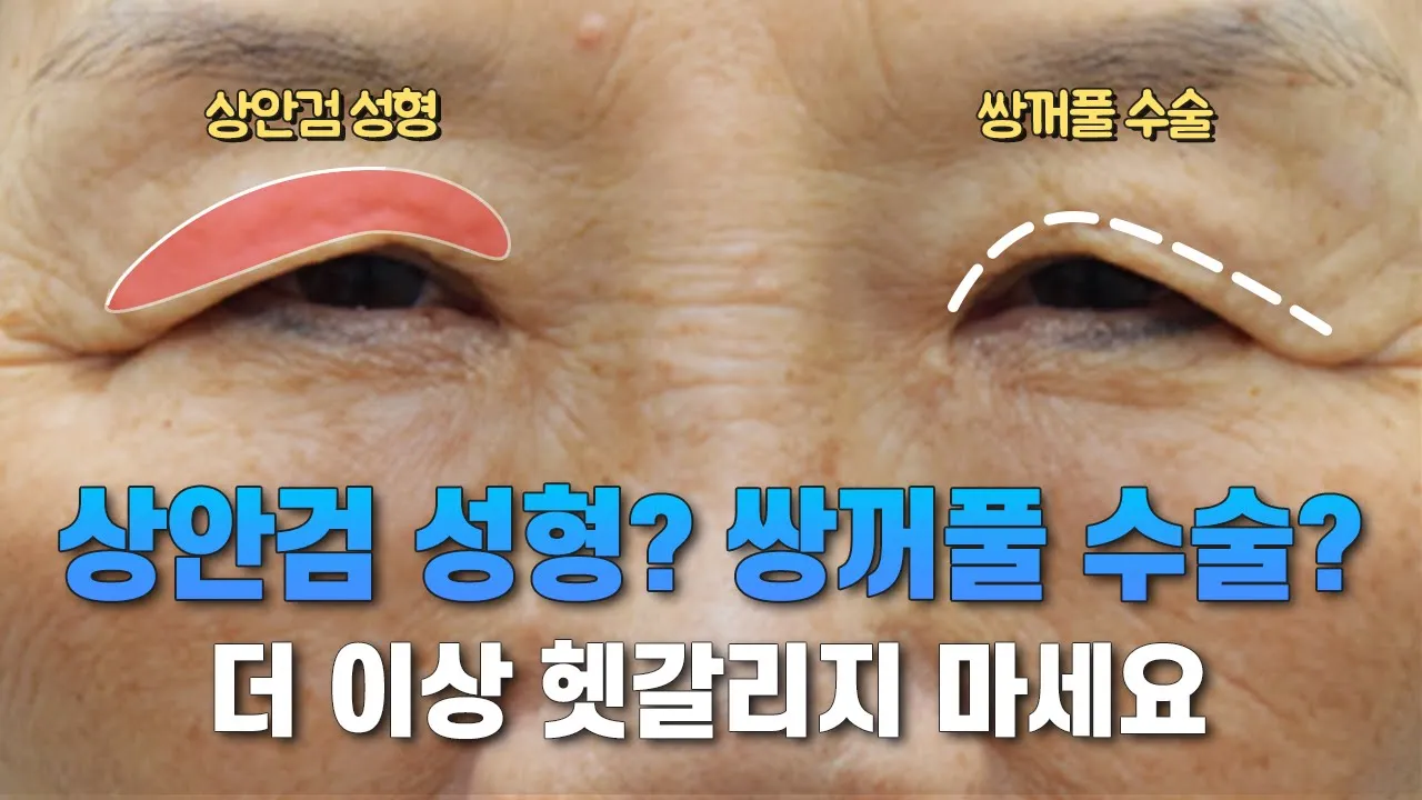 상안검 성형과 쌍꺼풀 수술의 차이점 | 압구정김원장
