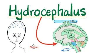 Hydrocephalus -Communicating, Noncommunicating Hydrocephalus,Normal Pressure Hydrocephalus,Ex vaccuo
