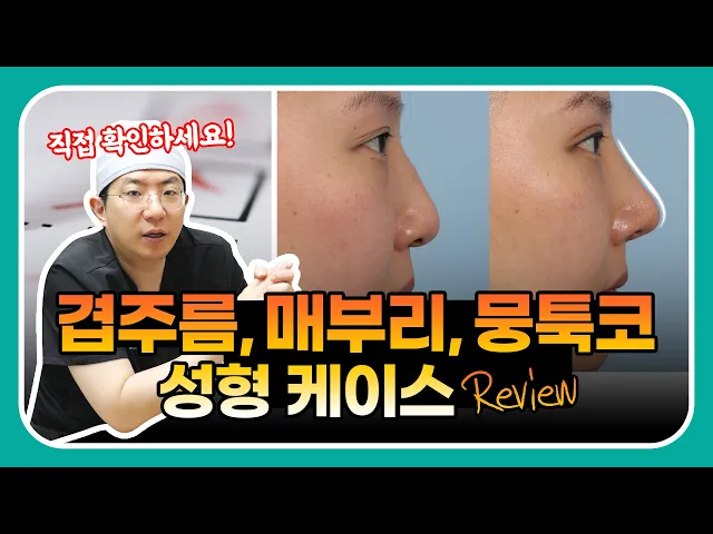 성형페이퍼ㅣ눈, 코 같이 성형해야 하는 이유