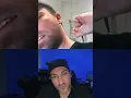 Longest ingrown hair ever