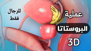 كيف تتم عملية استئصال البروستاتا بالليزر خطوة بخطوة 3D علاج تضخم البروستاتا نهائيا دروس طبية 
