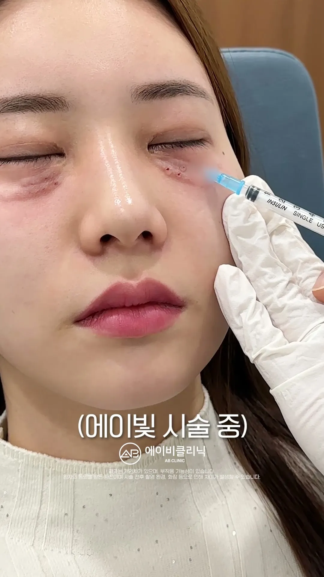 피부 상태별 맞춤 시술 과정
