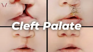 Download Why Cleft Palates Occur: A Scientific Explanation MP3