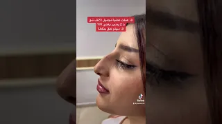 أجمل نتيجة تجميل الأنف في تركيا تجميل الانف تجميل الانف في تركيا تجميل انف 
