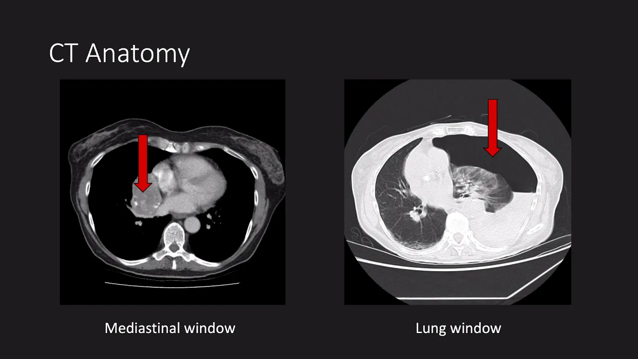 Introduction to thoracic CT