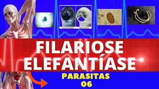 FILARIOSE - ELEFANTÍASE (WUCHERERIA BANCROFTI) - PARASITOLOGIA | INFECTOLOGIA