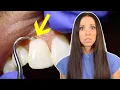 Can Scaling Teeth Ruin Your Tooth Enamel