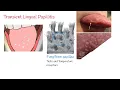 Transient lingual papillitis Lie Bumps - Inflammation of the tongue