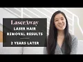 2 YEAR POST-LASER TREATMENT RESULTS LASERAWAY LASER HAIR REMOVAL EXPERIENCE PART 2