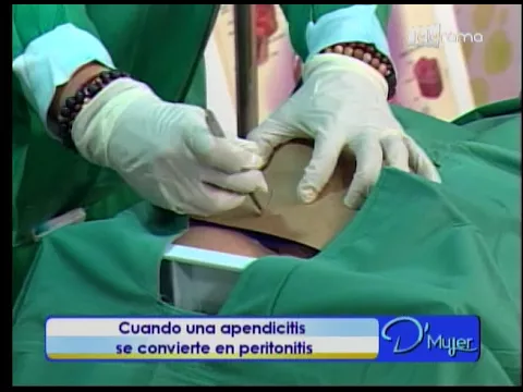 Cuando una apendicitis se convierte en peritonitis