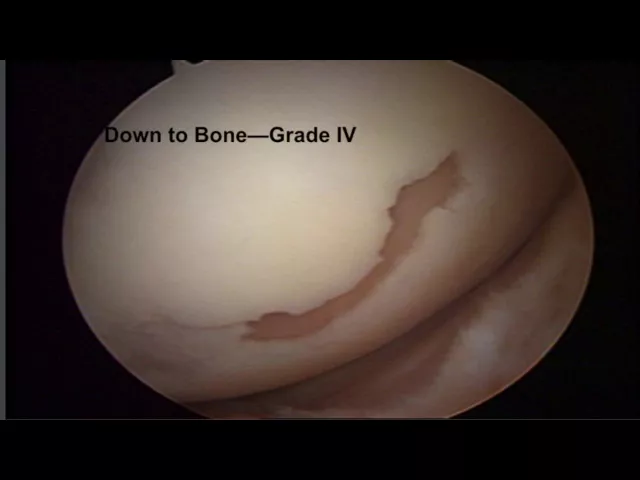 Knee Chondromalcia and Its Treatment