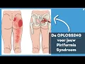 Download Lagu 'De OPLOSSING voor het Piriformis Syndroom' - Ga niet Rekken!