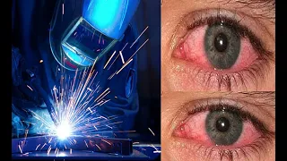 علاج التهاب العين بسبب فلاش ودخان اللحام دندنها