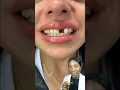 Download Lagu Making a FRONT TOOTH DENTURE #shorts #denture #missingtooth #youtubeshorts #teethbits #shortsfeed