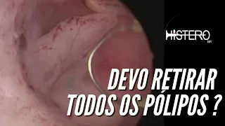 Devo retirar todos pólipos endometriais nas pacientes pós menopausa?