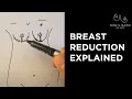 Breast Reduction Explained Nina S Naidu MD FACS NYC Female Plastic Surgeon
