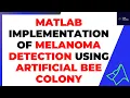 MATLAB Implementation of Melanoma detection using Artificial Bee Colony