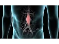 Abdominal Aortic Aneurysm AAA Repair
