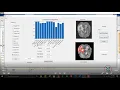 Brain tumor detection using different machine learning algorithm using MATLAB MATLAB solutions
