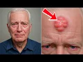 Download Lagu Man Notices Lump On Forehead—Doctor’s Reaction Shocks Everyone!