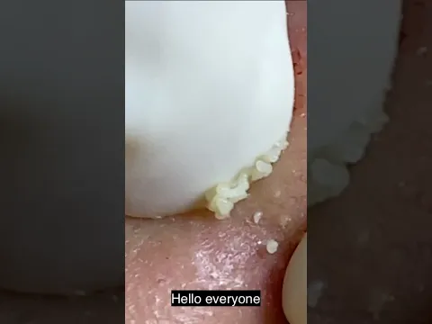 Acne Treatment Huong Da Nan#0014member#short# A New Beginning