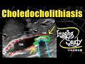 Choledocholithiasis Common Bile Duct Calculus Ultrasound Case 264