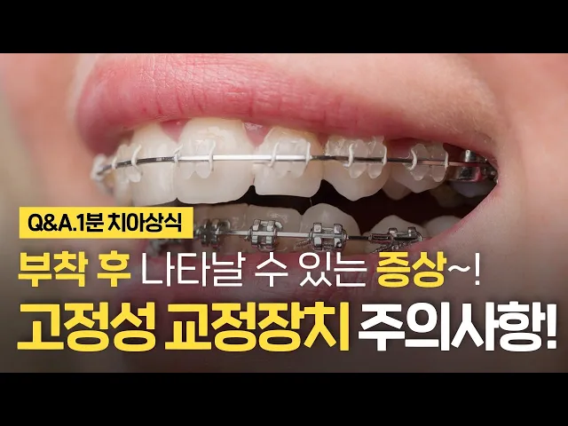 고정성 교정장치 사용 부착시 주의사항! ⏰1분 치아교정 상식 꿀팁!!