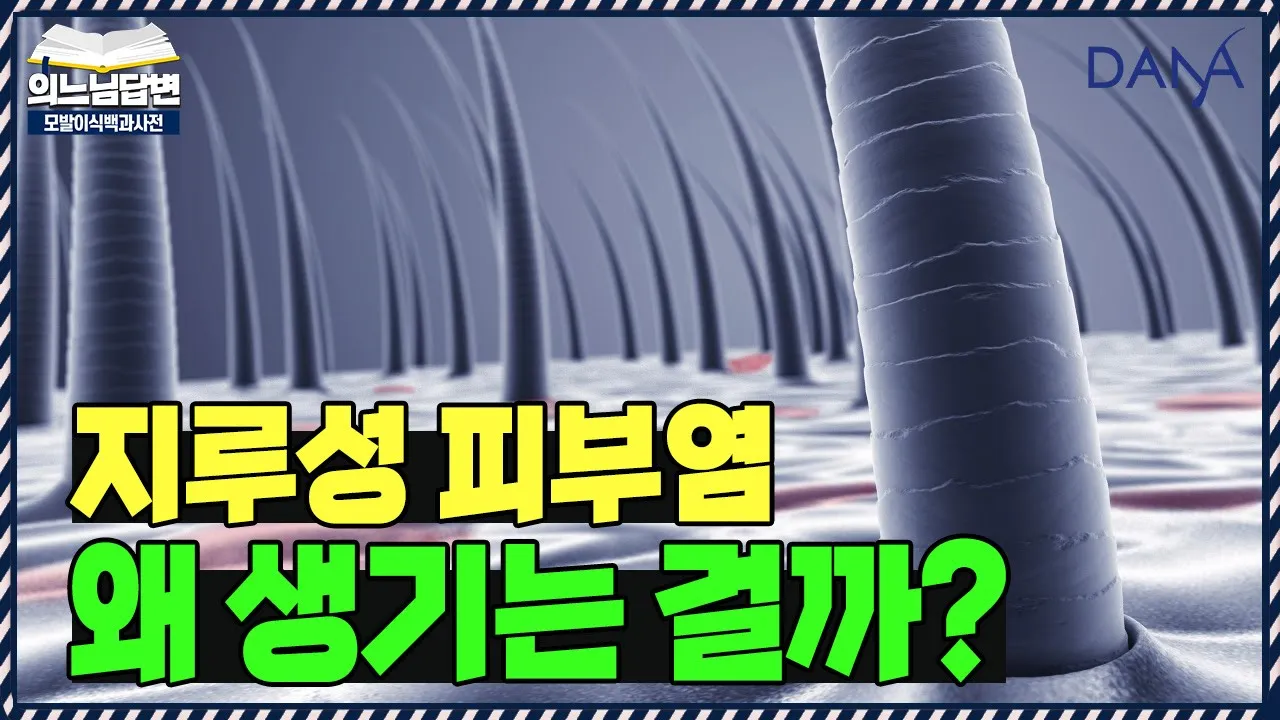 의느님답변📂지루성 두피염, 왜 생기는 걸까?ㅣ지루성 두피염의 모든것①ㅣ다나성형외과(DANA)ㅣ모발이식ㅣ헤어라인교정ㅣ두피문신ㅣ탈모치료