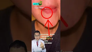هربس الفم  قرحة مش بسيطة      دندنها