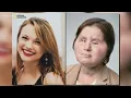 Face transplant recipient gets second chance after failed suicide attempt
