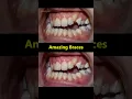 Download Lagu Amazing braces. Fix underbite teeth, 40 month journey #braces #dentist #orthodontist #teeth