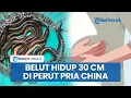 Download Lagu Pria di China Alami Sakit Perut Hebat hingga Keras, Ditemukan Belut Hidup Sepanjang 30 Cm di Usus