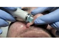 My HydraFacial Experience