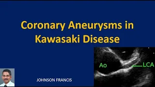Coronary Aneurysms in Kawasaki Disease