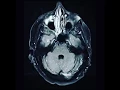 Download Lagu Breast cancer metastases to the brain - MRI
