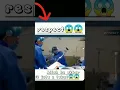 Download Lagu beginilah cara dokter ortopedi melepaskan pen logam di kaki yang patah😱Jam 14.02 # subscribe yah