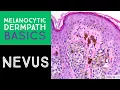 Melanocytic Dermpath Basics Benign Nevus