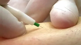 Complete Apilus Electrolysis Permanent Hair Removal Treatment