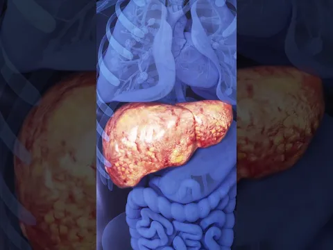 From Healthy to Scarred: Understanding Cirrhosis 🩺
