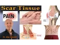 Your Chronic Pain May Actually Be Scar Tissue - Dr Mandell