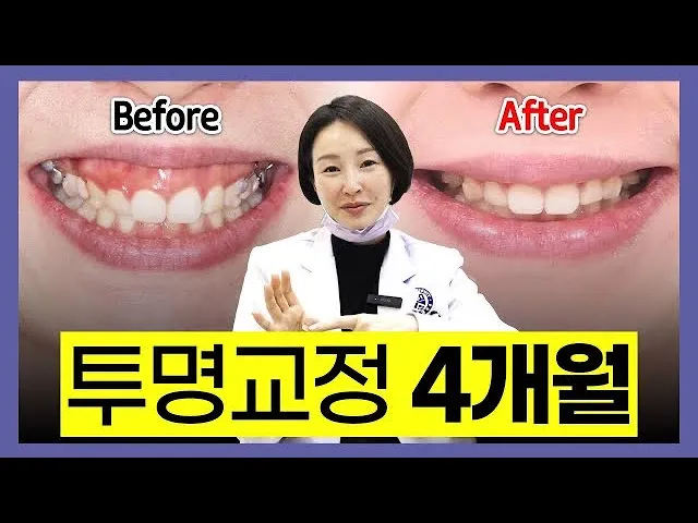 투명교정으로 잇몸 돌출 해결하는 방법, 발치교정, 거미스마일 해결