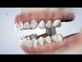 What Is Full-Arch Restoration in Oklahoma City OK Oral Surgery Specialists of Oklahoma