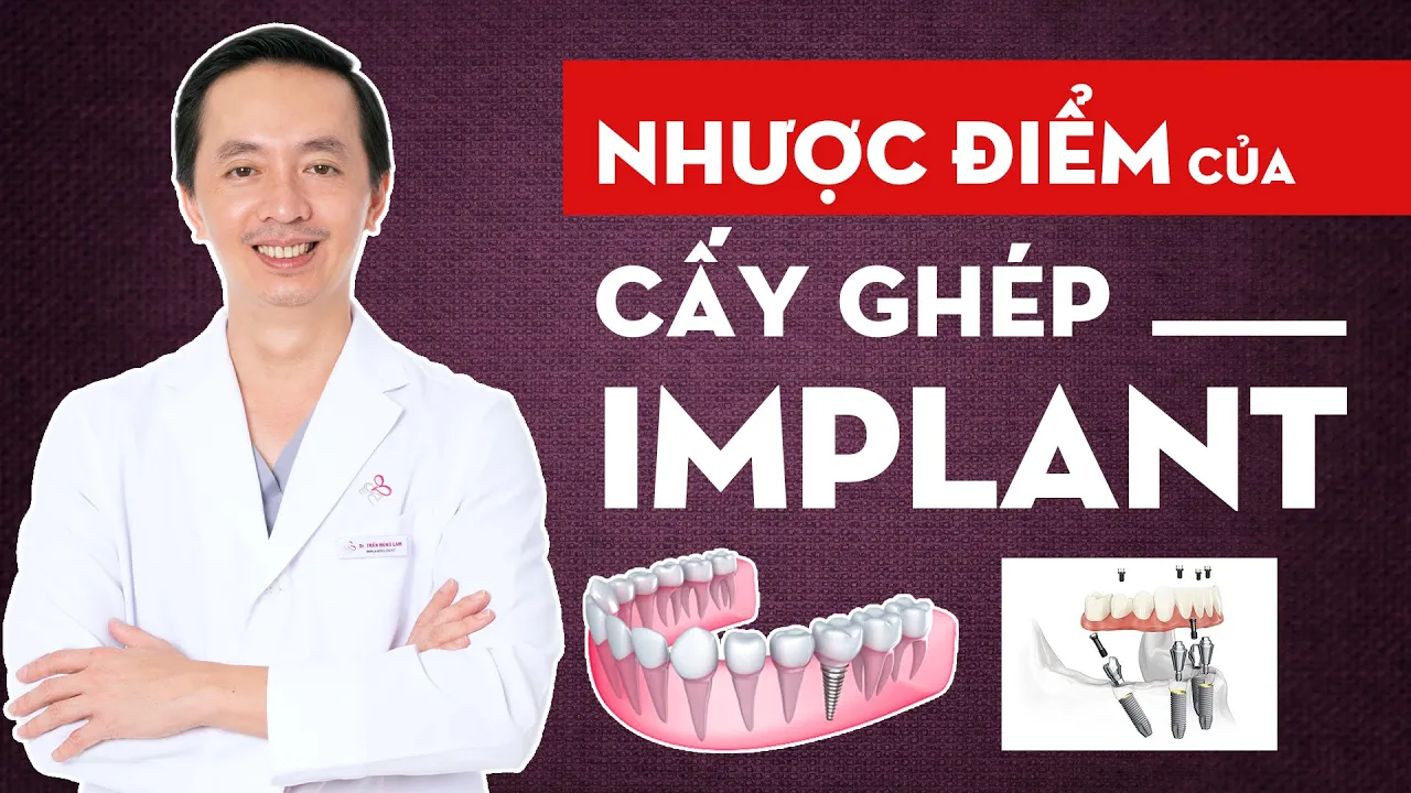 Outline Video Nhược điểm của cấy ghép implant - Nhược điểm trong trồng răng implant là gì?