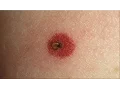 How to Spot and Prevent Lyme Disease WebMD
