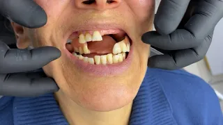Por qué se cae tu PRÓTESIS DENTAL?
