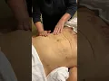 Post Lipo Lymphatic Drainage