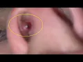 how to get rid of a piercing bump inside nose tutorial