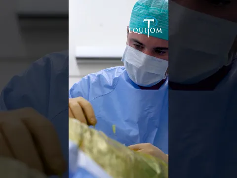 Kystes osseux : Les vis résorbables révolutionnent le traitement !